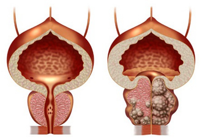 benigna hiperplazija prostate prirodno liječenje prostatita si coccis