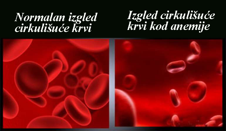 Анемия стоп. Клетки крови эритроциты. Iron deficiency anemia.