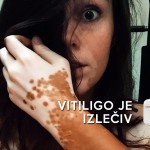 Vitiligo je izlečiv